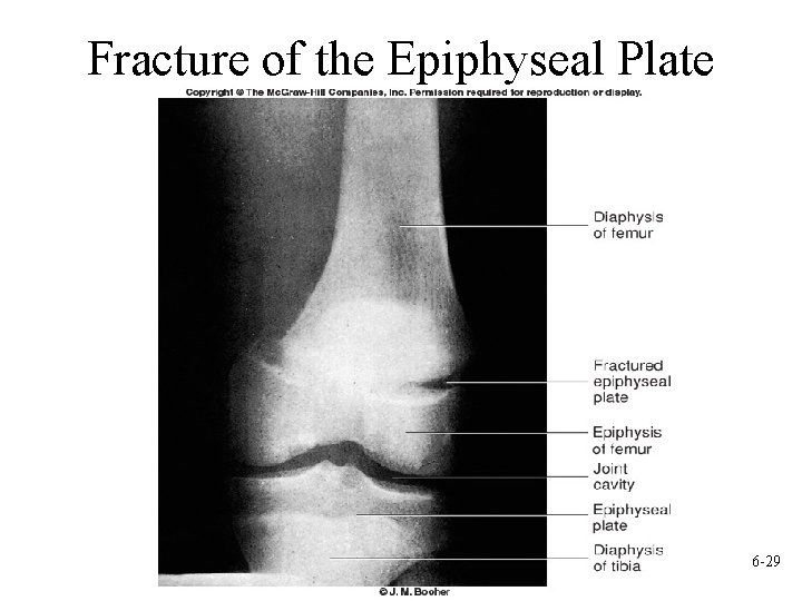 Fracture of the Epiphyseal Plate 6 -29 