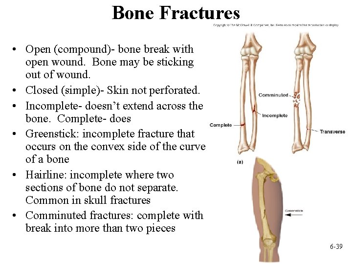 Bone Fractures • Open (compound)- bone break with open wound. Bone may be sticking