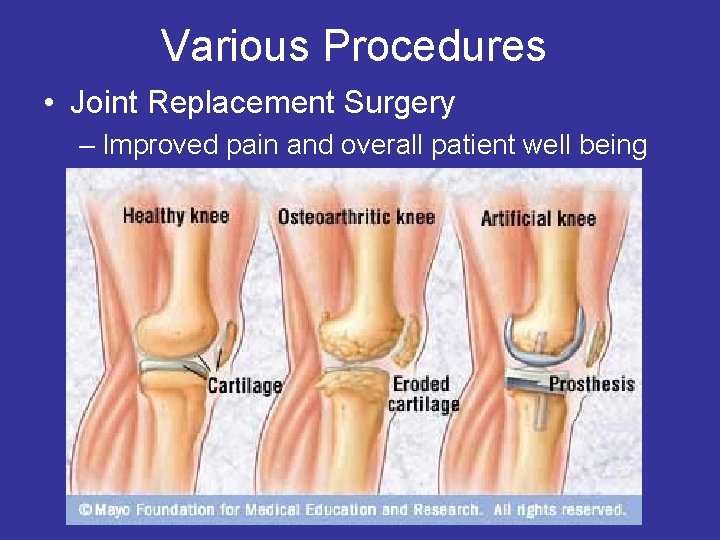 Various Procedures • Joint Replacement Surgery – Improved pain and overall patient well being