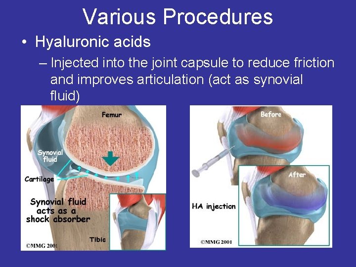 Various Procedures • Hyaluronic acids – Injected into the joint capsule to reduce friction