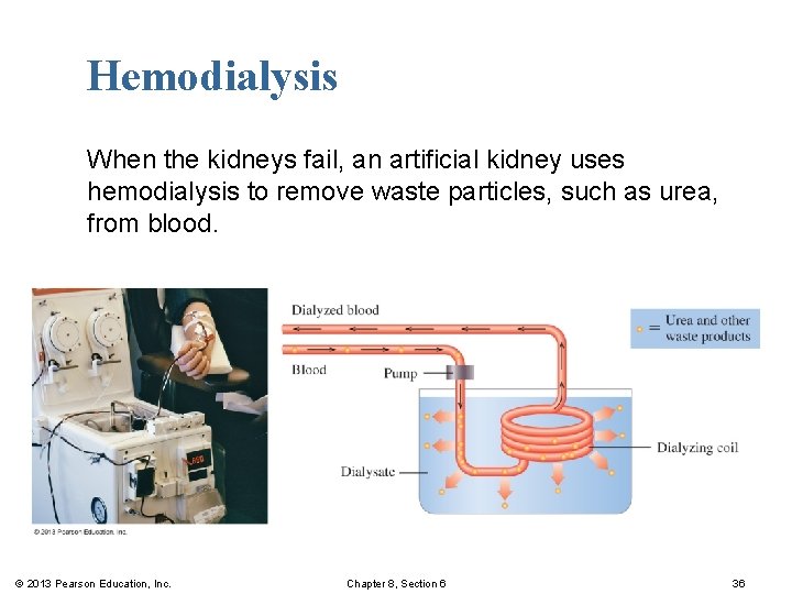 Hemodialysis When the kidneys fail, an artificial kidney uses hemodialysis to remove waste particles,