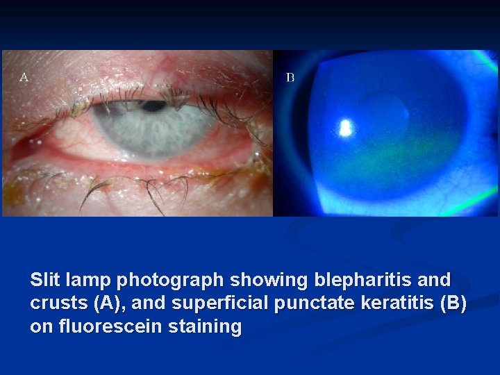 Slit lamp photograph showing blepharitis and crusts (A), and superficial punctate keratitis (B) on
