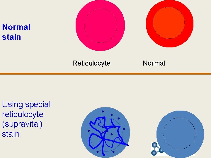 Normal stain Reticulocyte Using special reticulocyte (supravital) stain Normal 