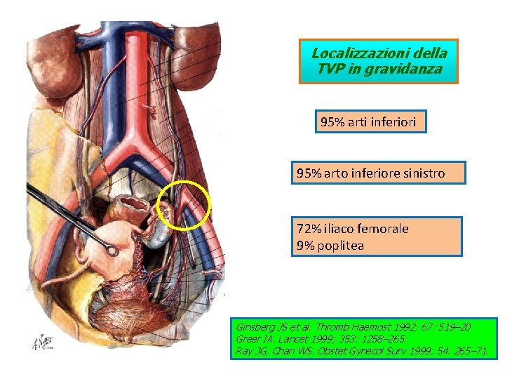 Localizzazioni della TVP in gravidanza 95% arti inferiori 95% arto inferiore sinistro 72% iliaco