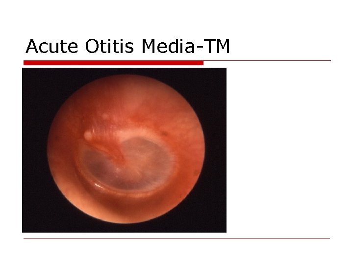 Acute Otitis Media-TM 