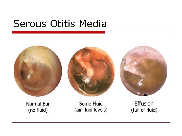 Serous Otitis Media 