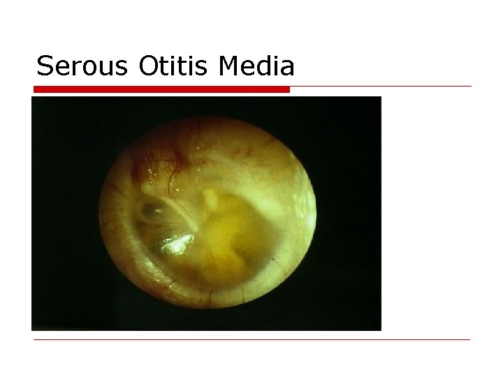 Serous Otitis Media 