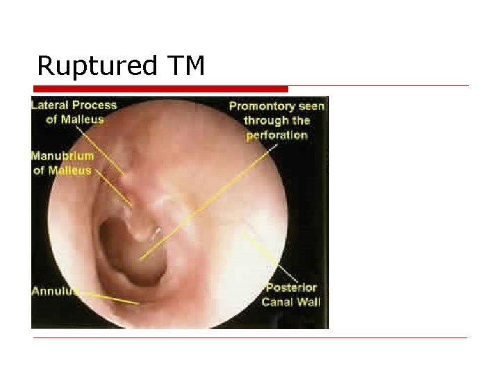 Ruptured TM 