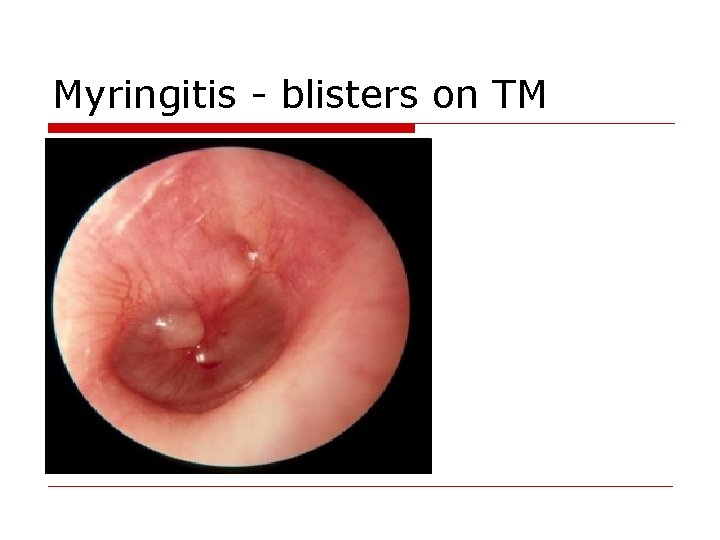 Myringitis - blisters on TM 