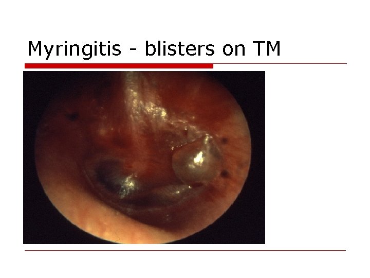 Myringitis - blisters on TM 