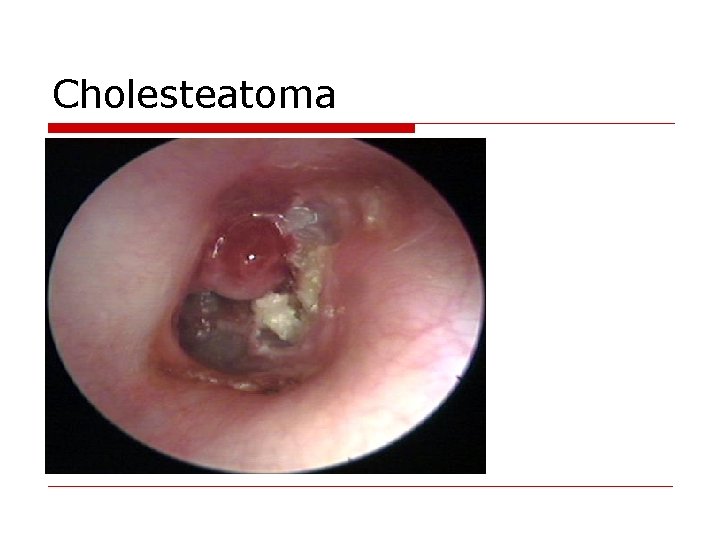 Cholesteatoma 