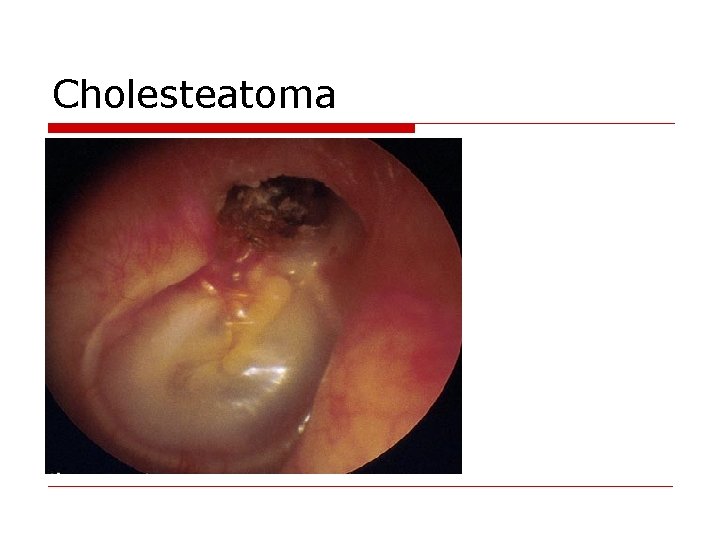 Cholesteatoma 