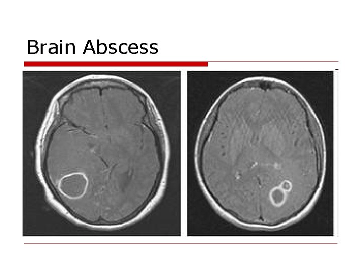 Brain Abscess 