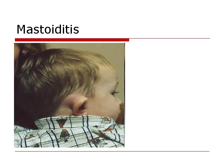 Mastoiditis 