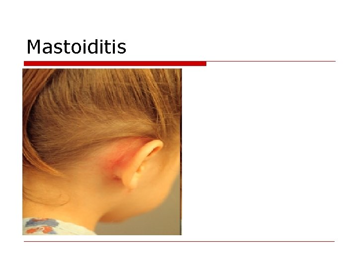 Mastoiditis 