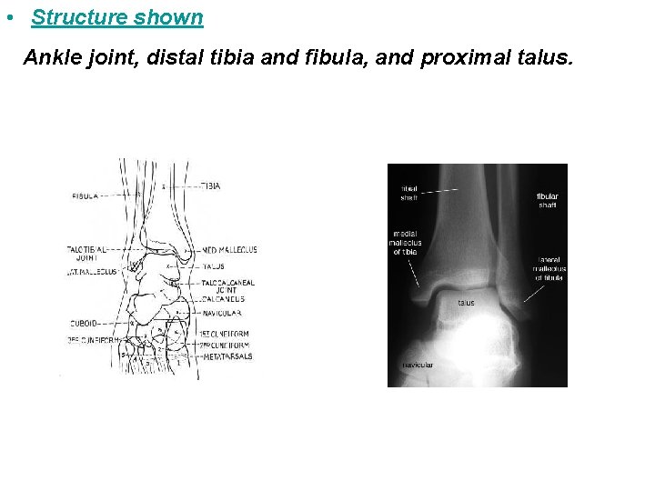  • Structure shown Ankle joint, distal tibia and fibula, and proximal talus. 