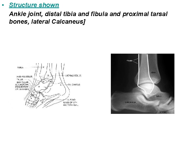  • Structure shown Ankle joint, distal tibia and fibula and proximal tarsal bones,