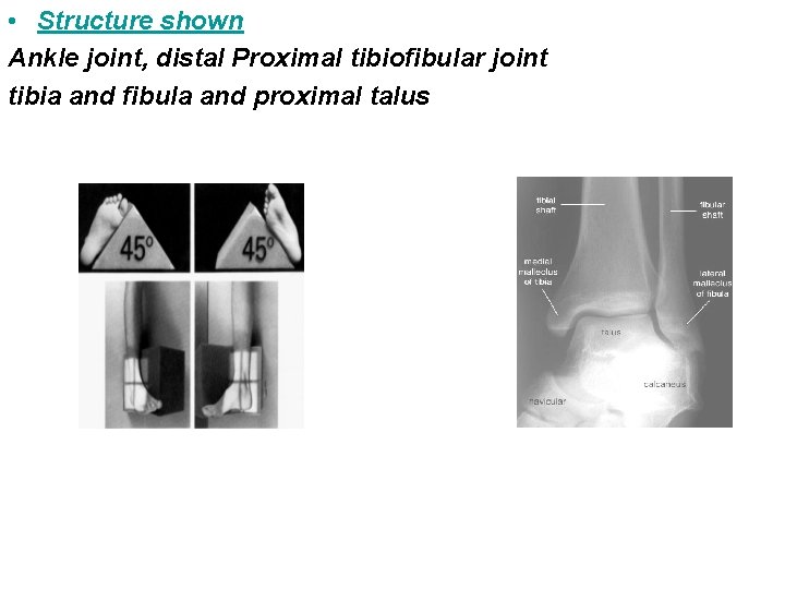  • Structure shown Ankle joint, distal Proximal tibiofibular joint tibia and fibula and