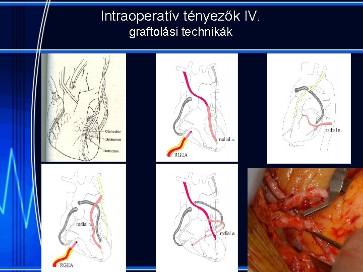 Intraoperatív tényezők IV. graftolási technikák 