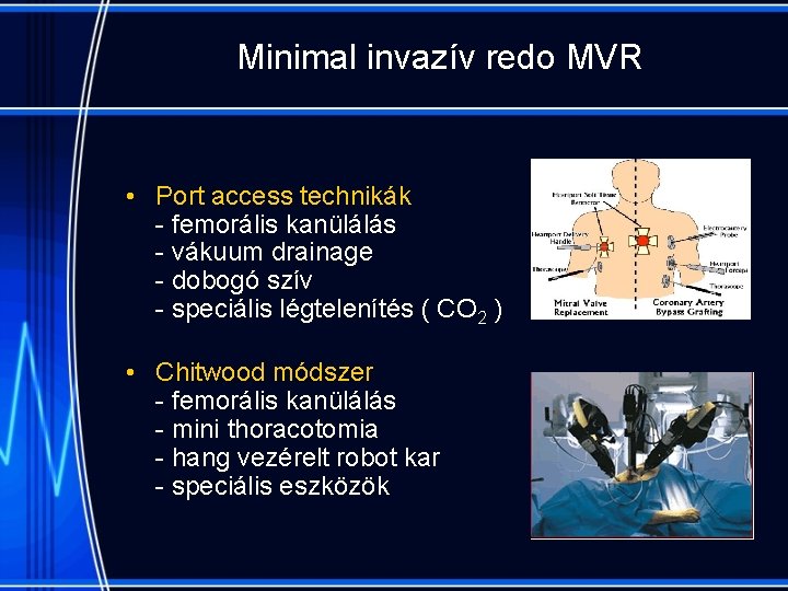 Minimal invazív redo MVR • Port access technikák - femorális kanülálás - vákuum drainage