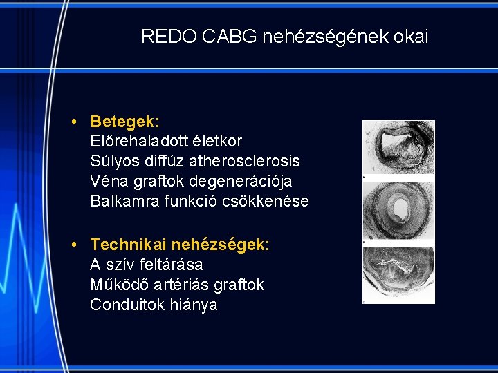 REDO CABG nehézségének okai • Betegek: Előrehaladott életkor Súlyos diffúz atherosclerosis Véna graftok degenerációja