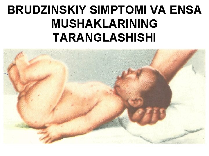 BRUDZINSKIY SIMPTOMI VA ENSA MUSHAKLARINING TARANGLASHISHI 