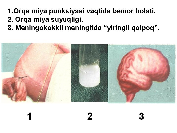 1. Orqa miya punksiyasi vaqtida bemor holati. 2. Orqa miya suyuqligi. 3. Meningokokkli meningitda