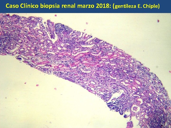 Caso Clínico biopsia renal marzo 2018: (gentileza E. Chiple) 