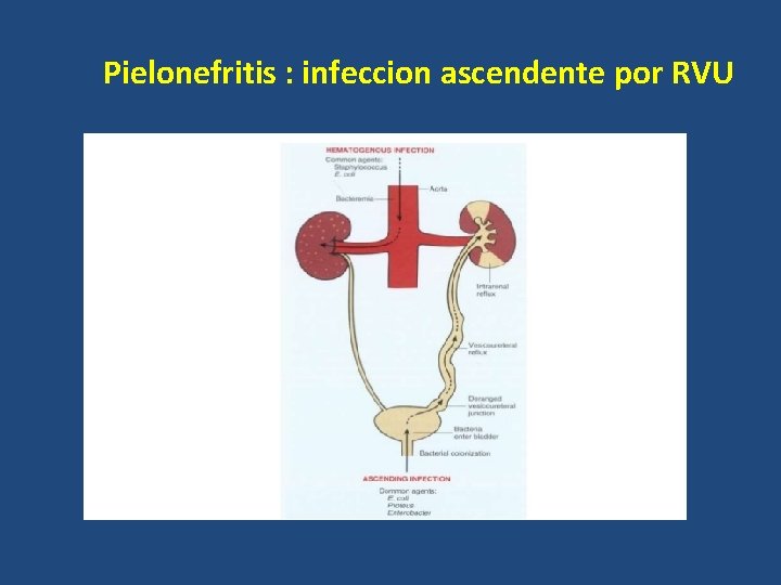 Pielonefritis : infeccion ascendente por RVU 