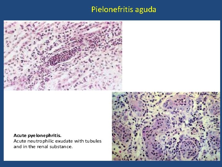 Pielonefritis aguda 