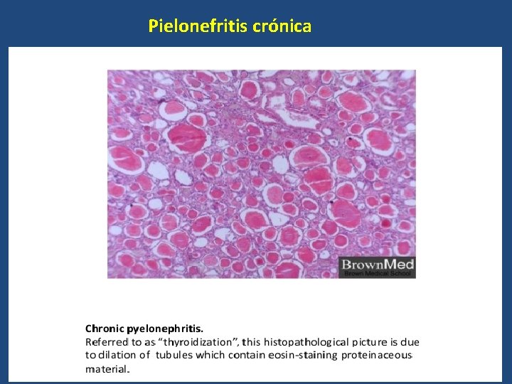 Pielonefritis crónica 