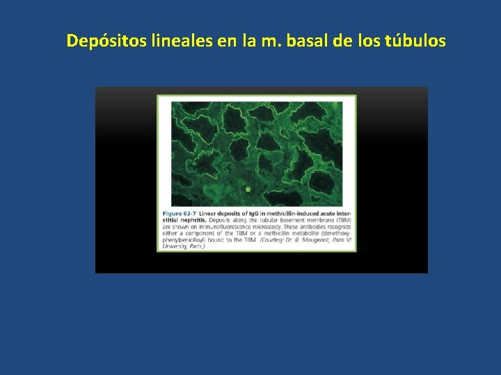 Depósitos lineales en la m. basal de los túbulos 