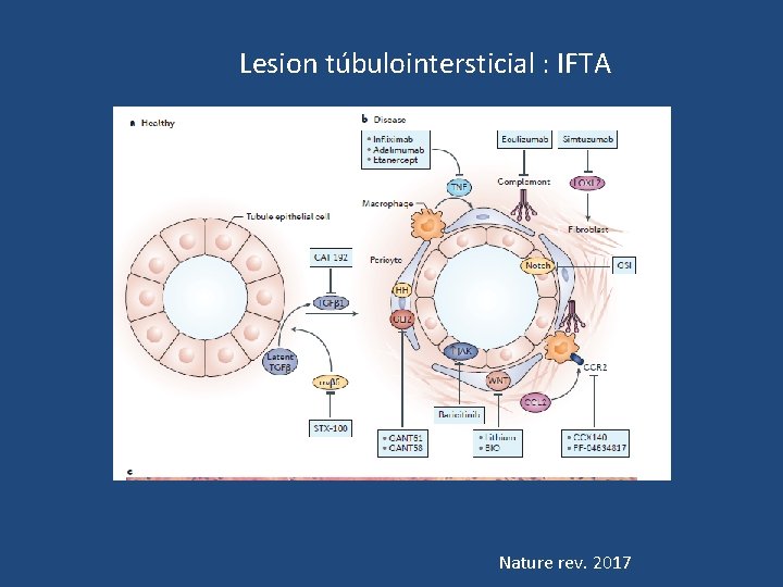 Lesion túbulointersticial : IFTA Nature rev. 2017 