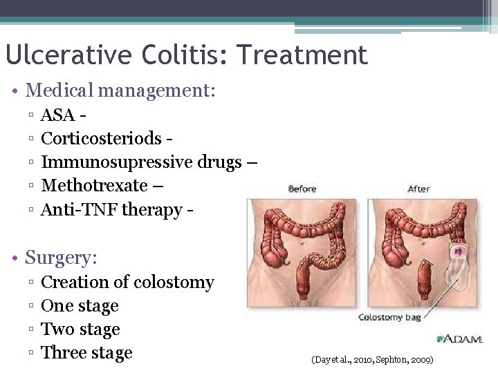 Ulcerative Colitis: Treatment • Medical management: ▫ ▫ ▫ ASA Corticosteriods Immunosupressive drugs –