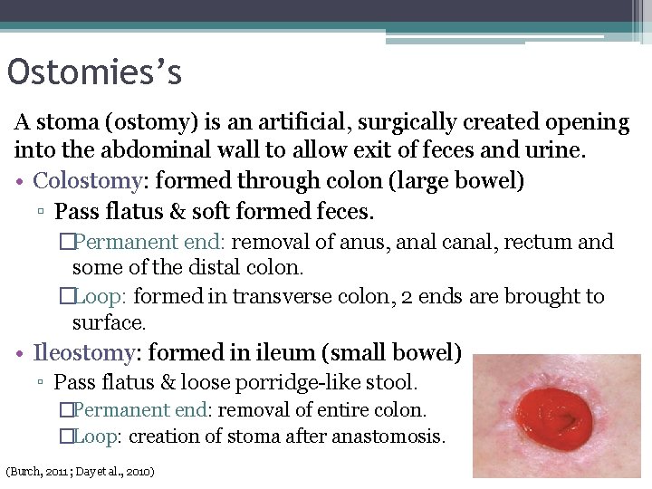Ostomies’s A stoma (ostomy) is an artificial, surgically created opening into the abdominal wall