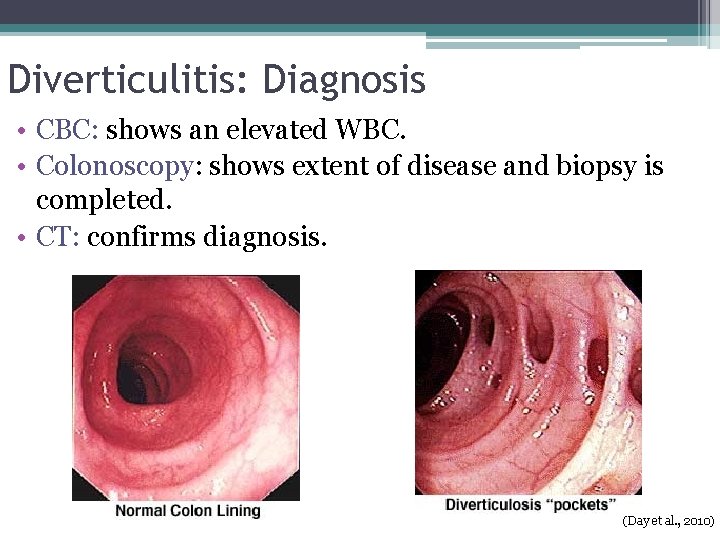 Diverticulitis: Diagnosis • CBC: shows an elevated WBC. • Colonoscopy: shows extent of disease