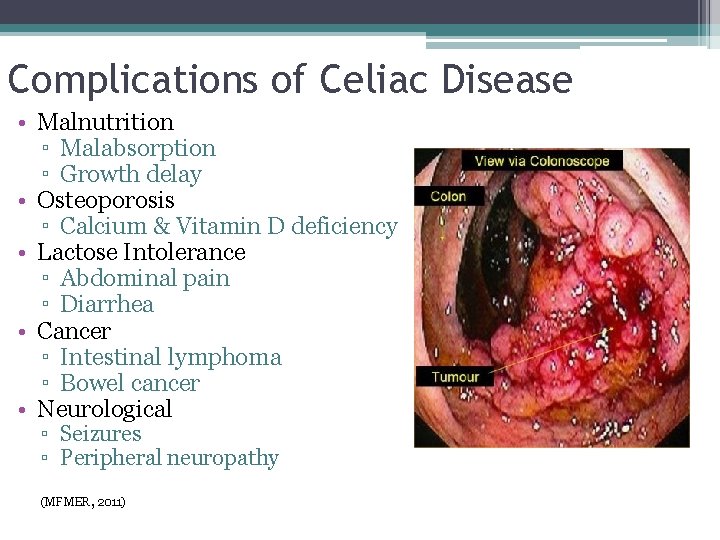 Complications of Celiac Disease • Malnutrition ▫ Malabsorption ▫ Growth delay • Osteoporosis ▫