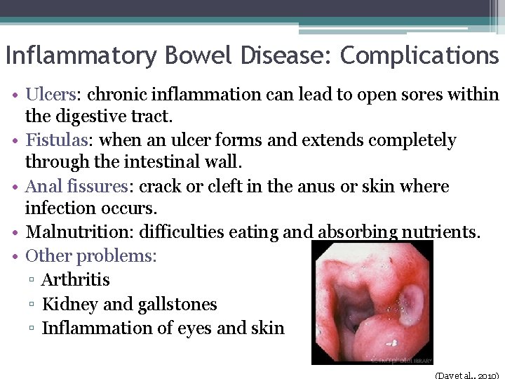 Inflammatory Bowel Disease: Complications • Ulcers: chronic inflammation can lead to open sores within