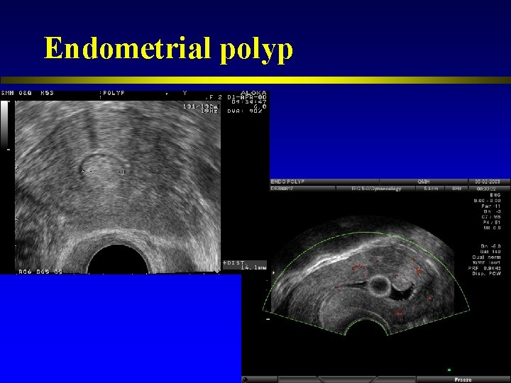 Endometrial polyp 