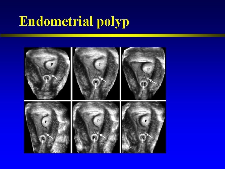 Endometrial polyp 