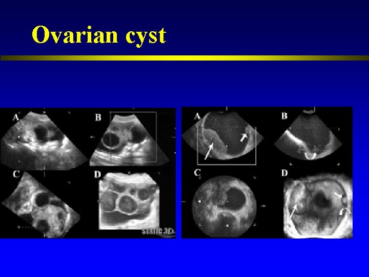Ovarian cyst 