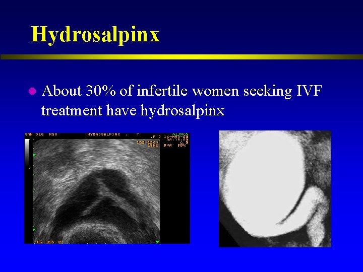 Hydrosalpinx l About 30% of infertile women seeking IVF treatment have hydrosalpinx 