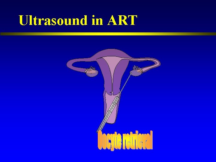 Ultrasound in ART 