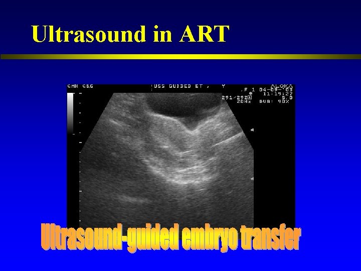 Ultrasound in ART 