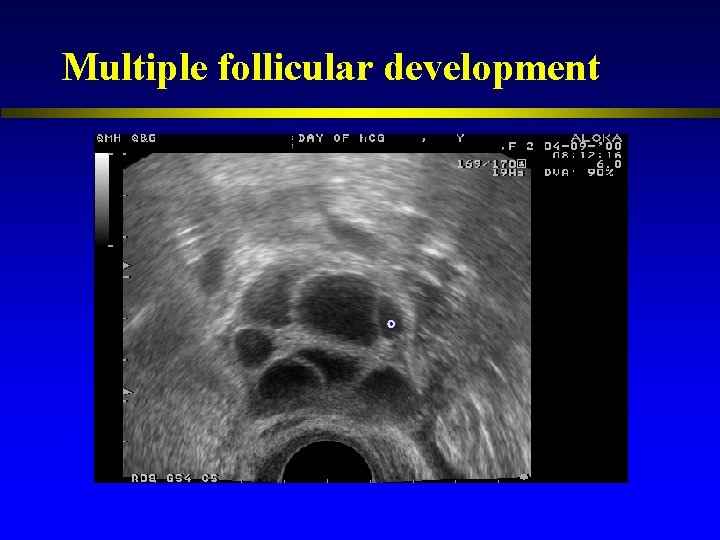 Multiple follicular development 