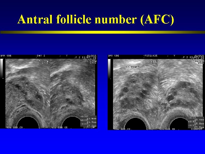 Antral follicle number (AFC) 
