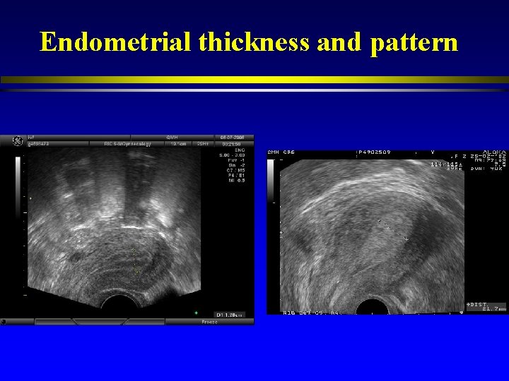 Endometrial thickness and pattern 