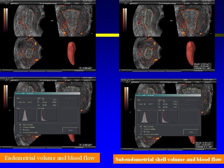 Endometrial volume and blood flow Subendometrial shell volume and blood flow 