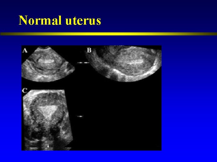 Normal uterus 
