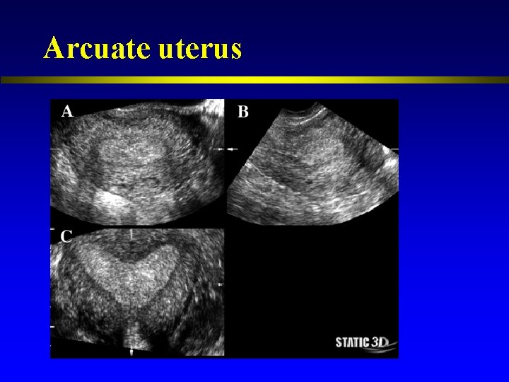 Arcuate uterus 